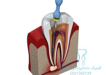 درمان ریشه دندان عصب کشی
