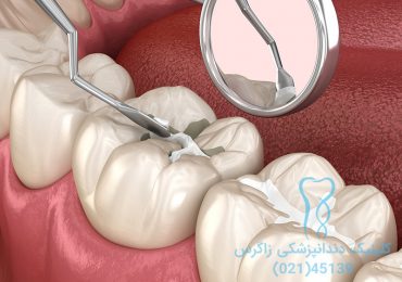 پر کردن دندان دندانپزشکی زاگرس