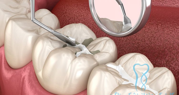 پر کردن دندان دندانپزشکی زاگرس