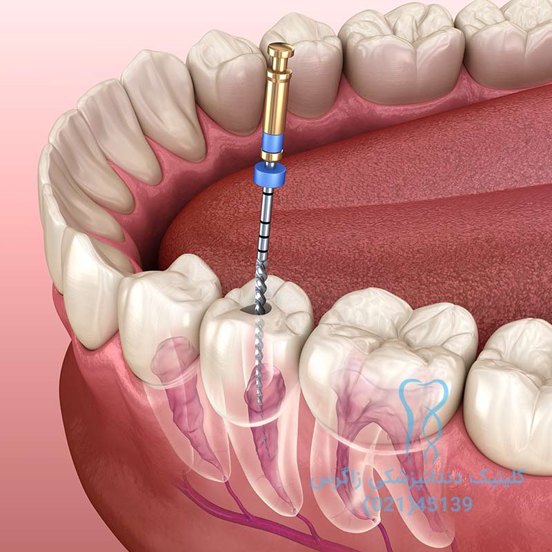درمان ریشه دندانپزشکی زاگرس