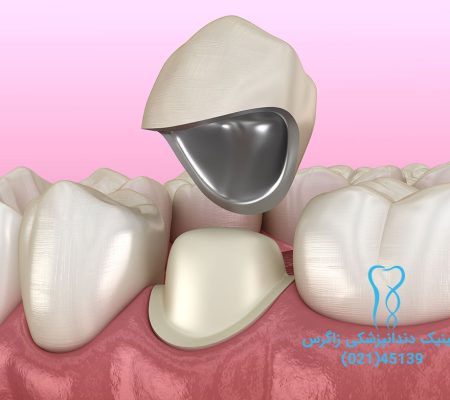 روکش دندان dental crown