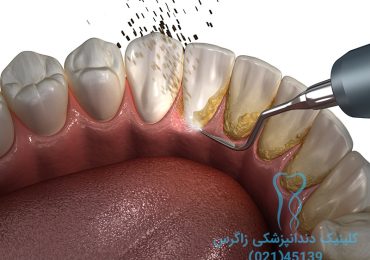 جرمگیری دندان با التراسونیک