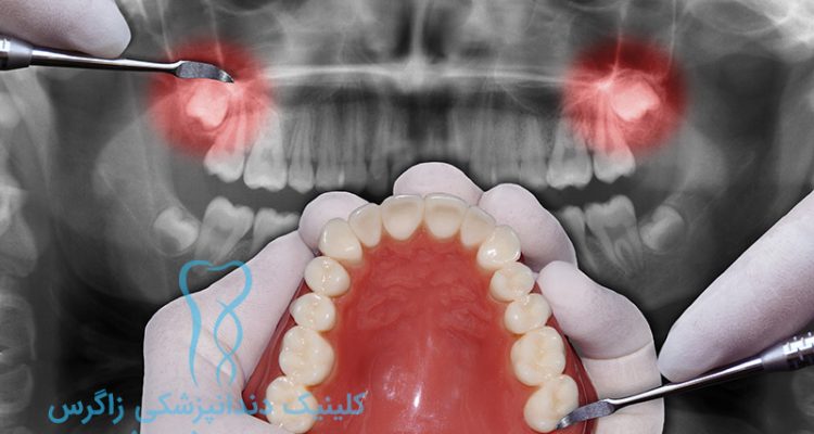 هزینه جراحی دندان عقل