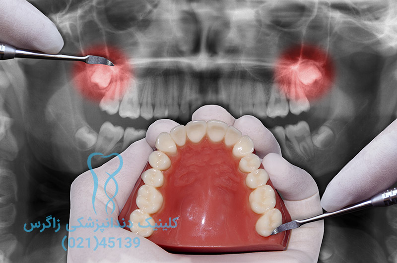 هزینه جراحی دندان عقل