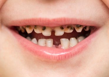 دلایل پوسیدگی دندان ها