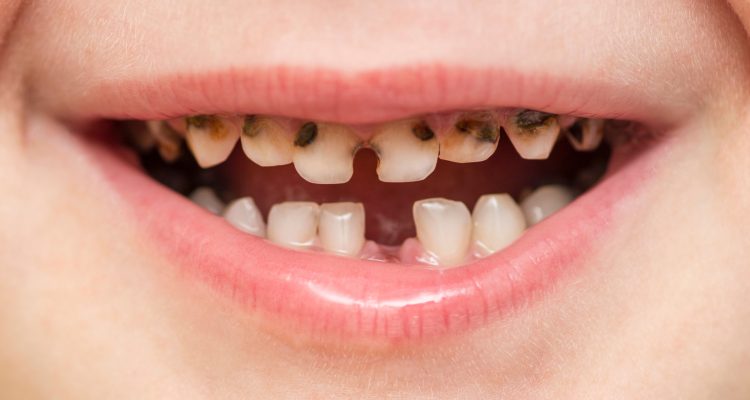 دلایل پوسیدگی دندان ها