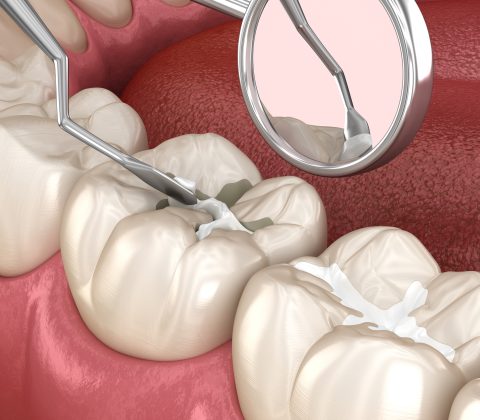 پرکردن های چند سطحی دندان ها