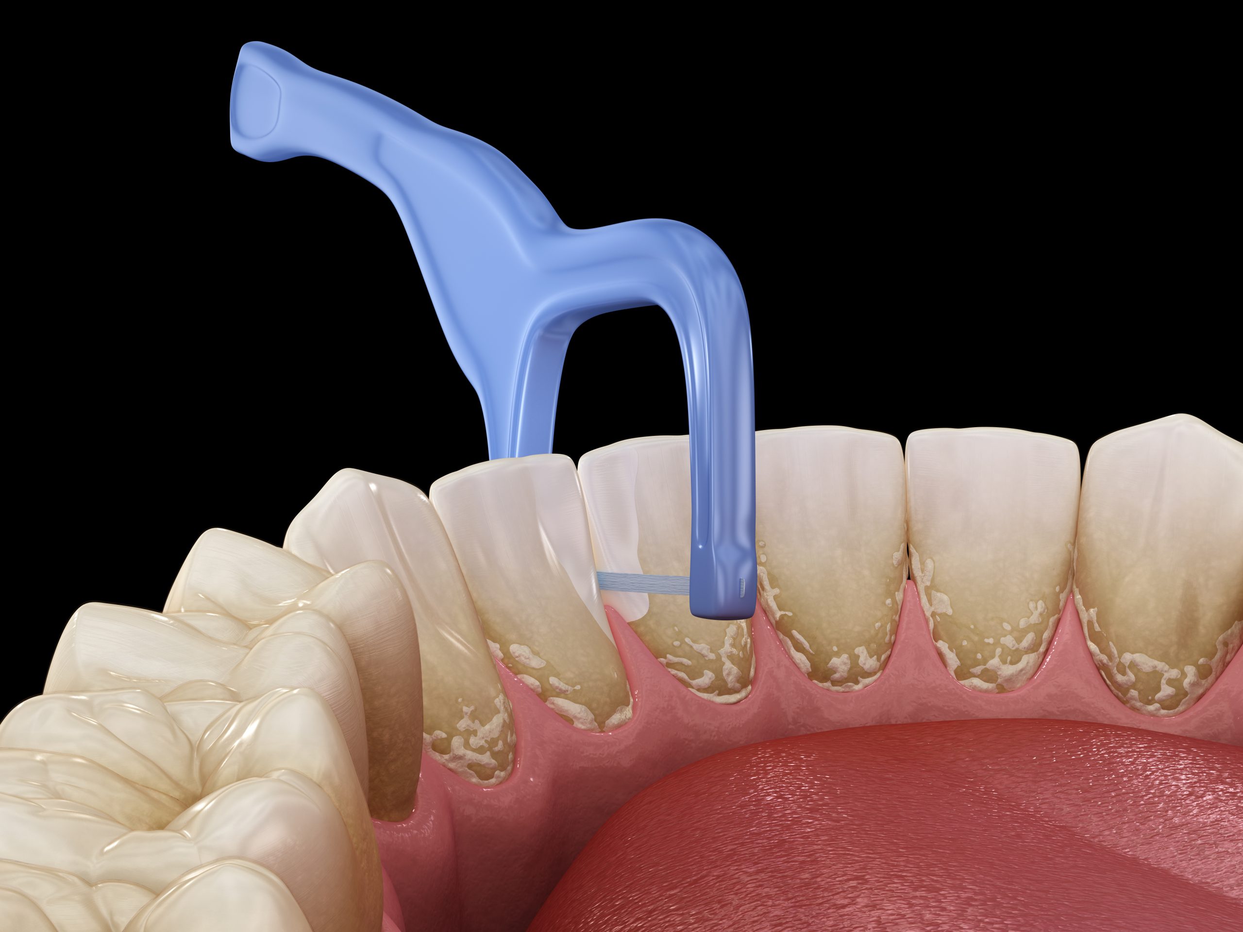 پیشگیری از پوسیدگی دندان با رعایت بهداشت دهان و دندان
