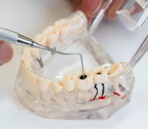 اهمیت جلوگیری از پوسیدگی دندان