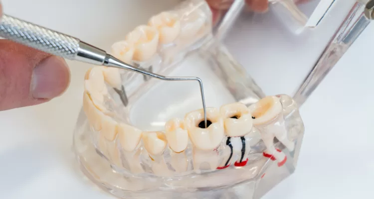 اهمیت جلوگیری از پوسیدگی دندان
