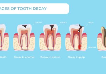 مراحل پوسیدگی دندان در صورت عدم پیشگیری و درمان