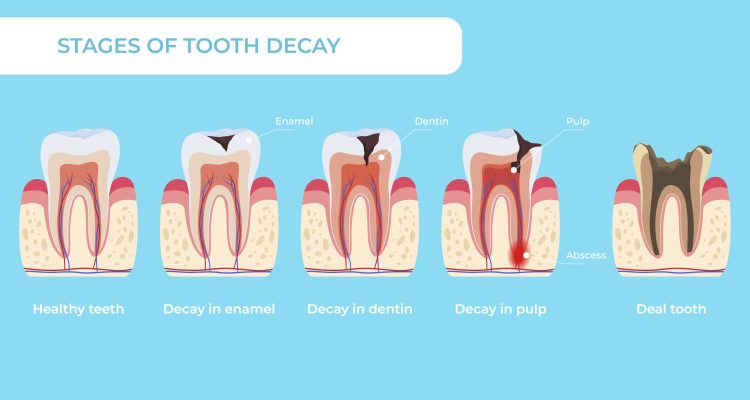 مراحل پوسیدگی دندان در صورت عدم پیشگیری و درمان