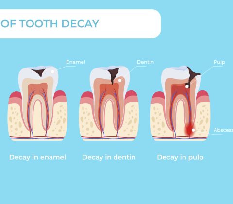 مراحل پوسیدگی دندان در صورت عدم پیشگیری و درمان