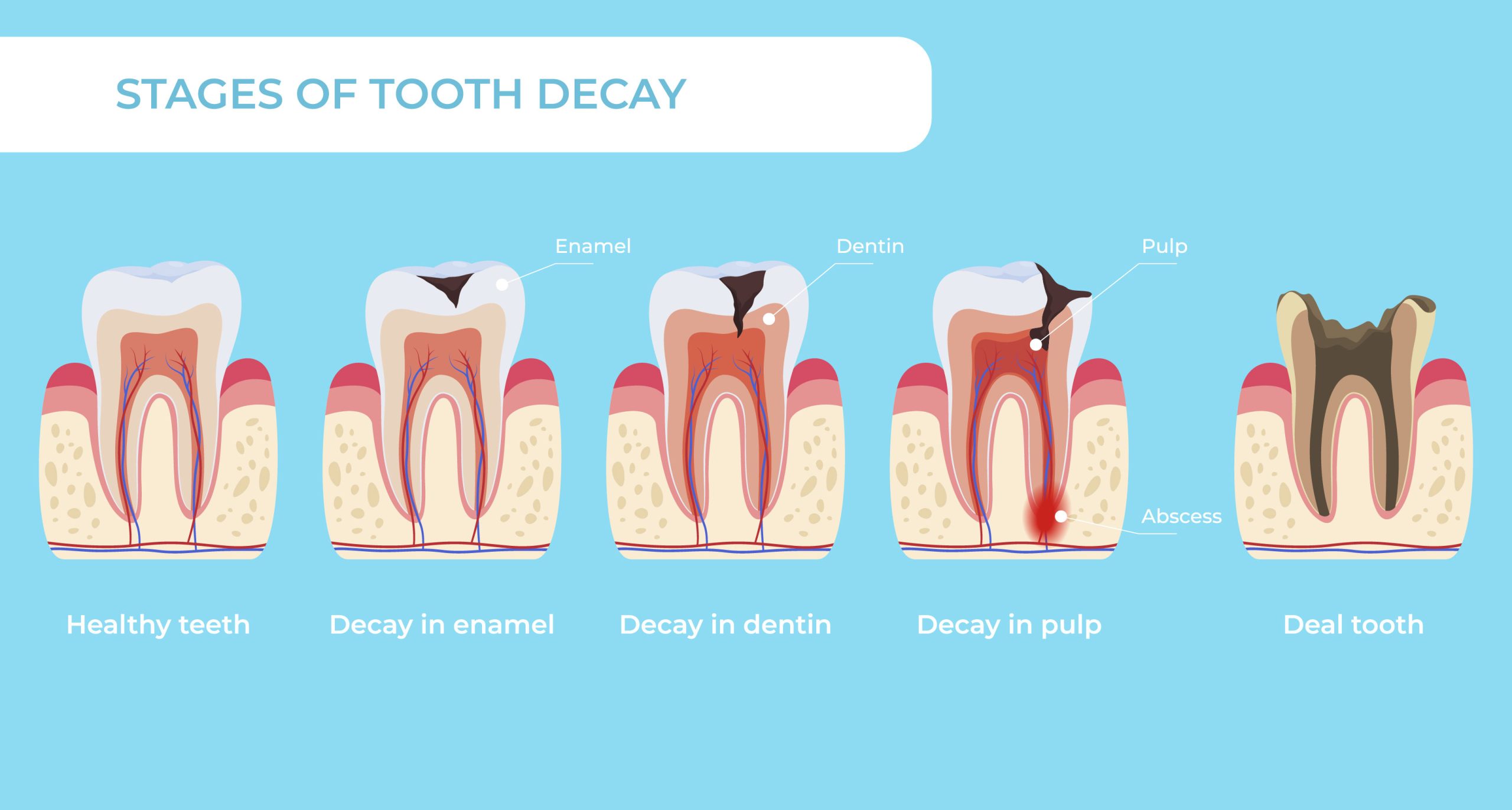 مراحل پوسیدگی دندان در صورت عدم پیشگیری و درمان