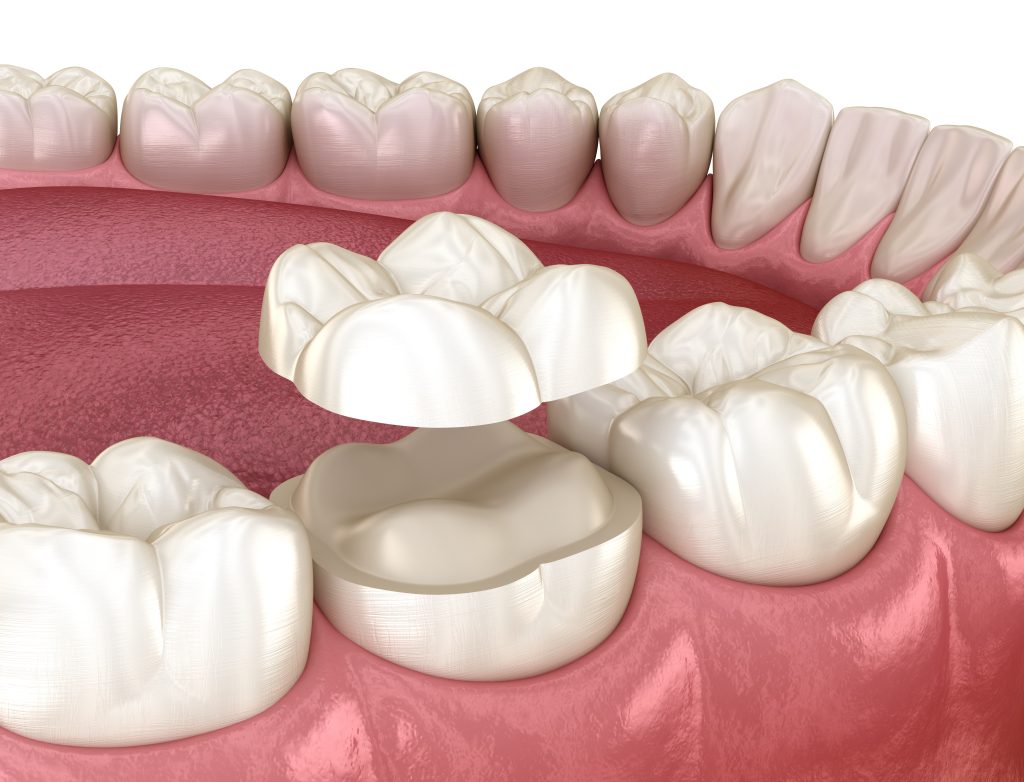 پروتزهای آنلی دندانپزشکی