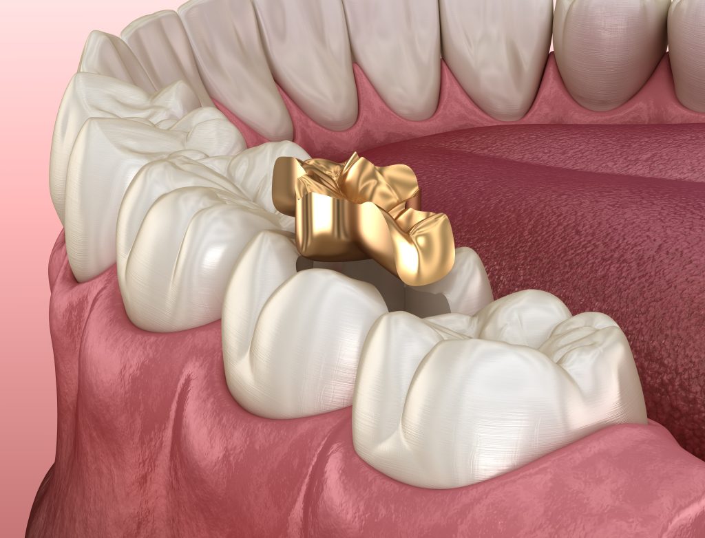 پروتز اینلی طلایی دندان در دندانپزشکی
