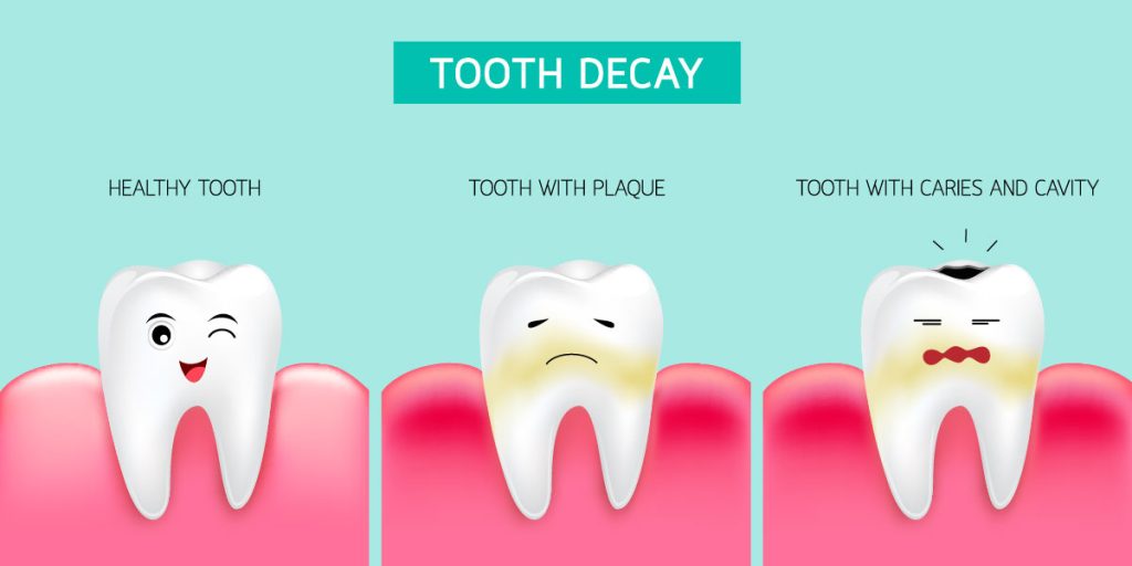 دندان دارای پلاک پوسیده می شود