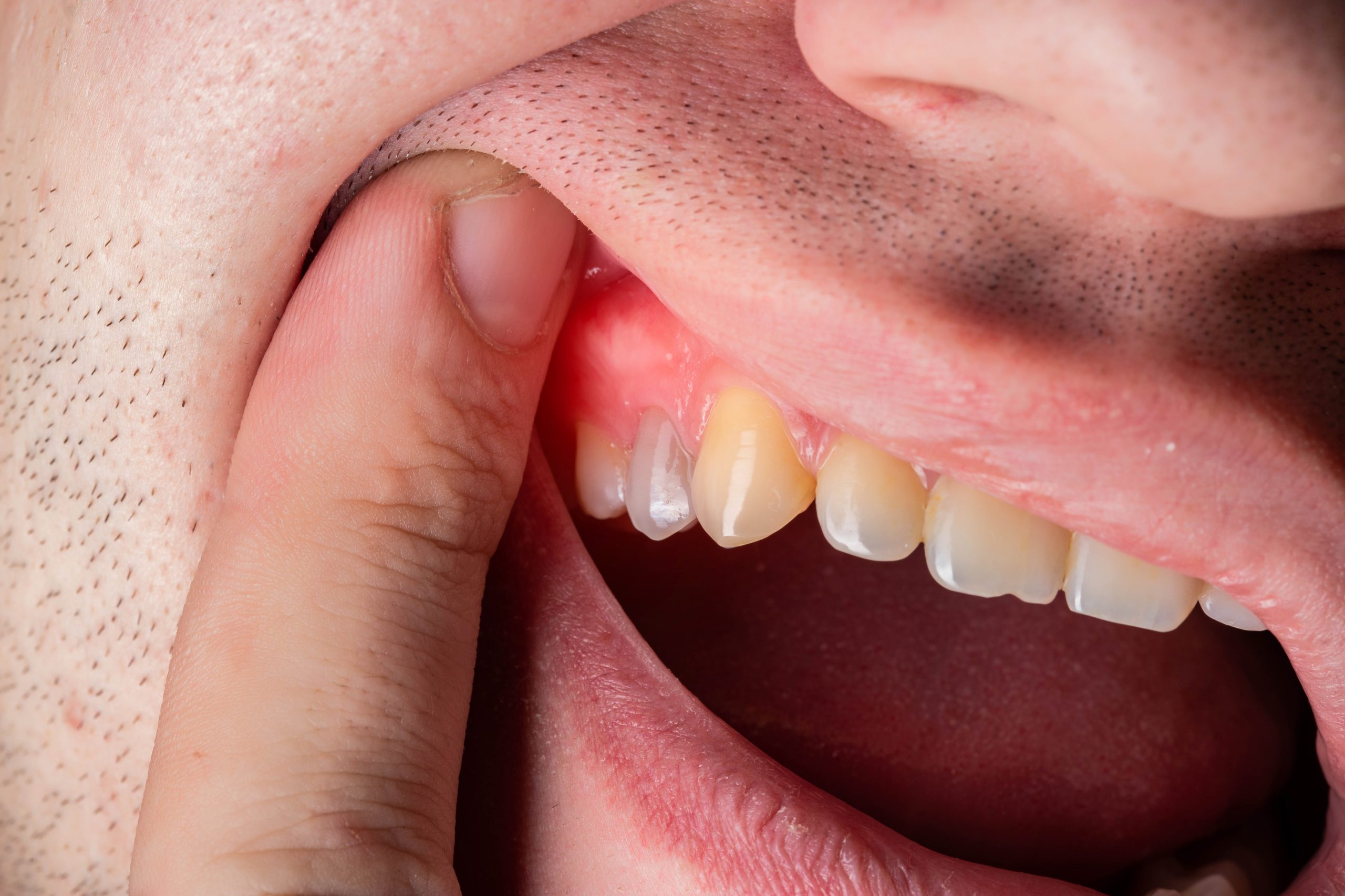 آبسه دندان چیست و عوامل بوجود آمدن آن - کلینیک دندانپزشکی شبانه روزی زاگرس