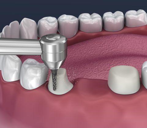 مراحل قالبگیری دندان تراش دندان برای گذاشتن روکش و بریج برای سه دندان