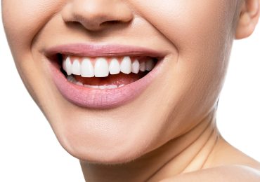 لمینیت های دندانی راه حلی مناسب برای بیمارانی با کیس های مناسب استفاده از لمینیت