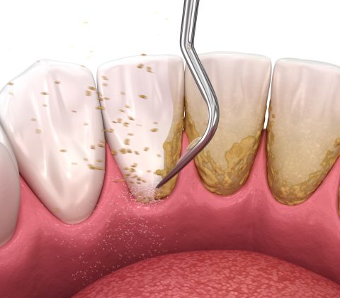 جرمگیری دندان دارای مزایای بسیاری برای حذف پلاک های دندانی