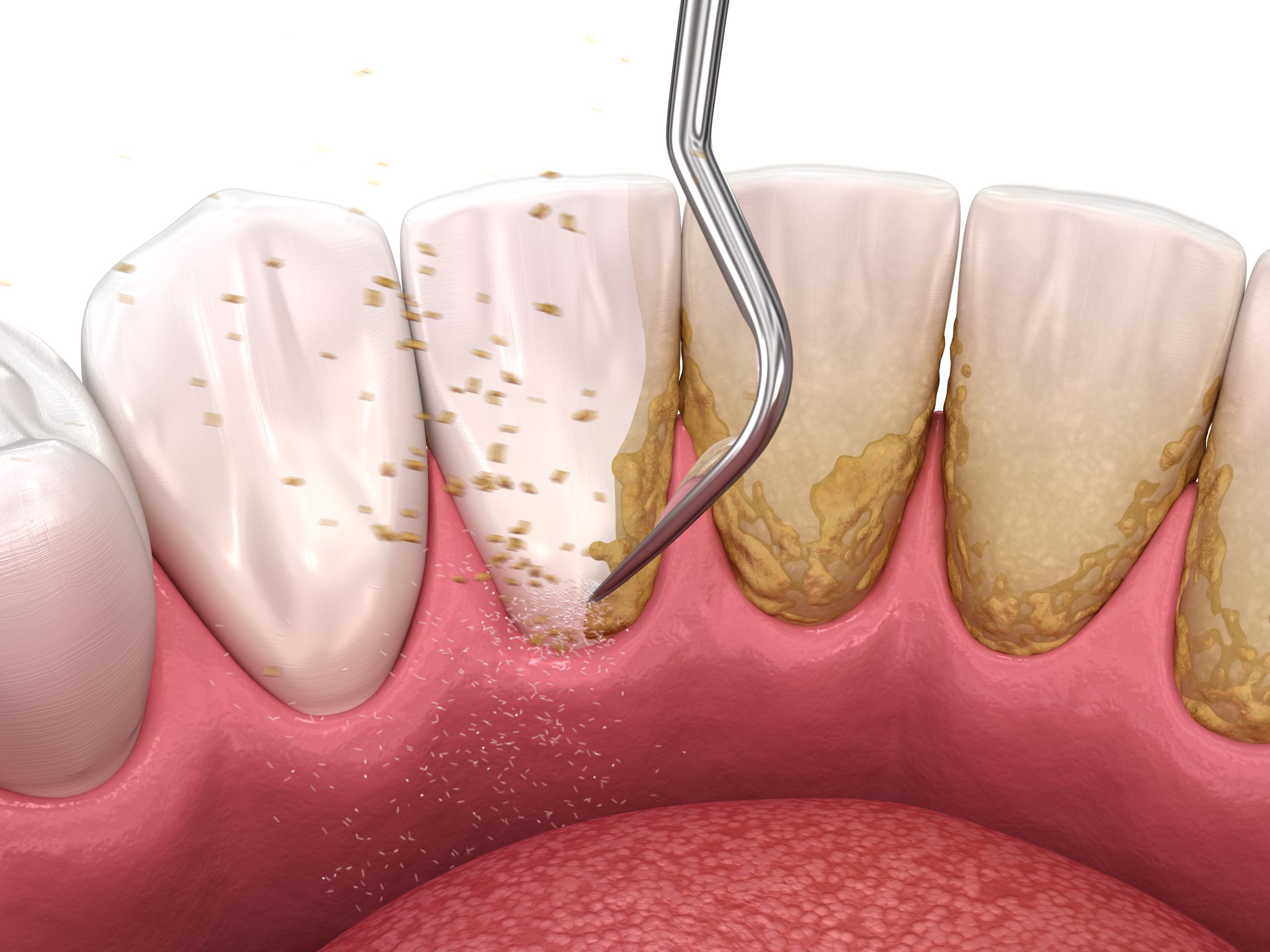 جرمگیری دندان دارای مزایای بسیاری برای حذف پلاک های دندانی