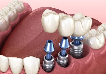 ایمپلنت دندانی، جراحی و گذاشتن فیکسچر های ایمپلنت و پروتزهای ایمپلنت