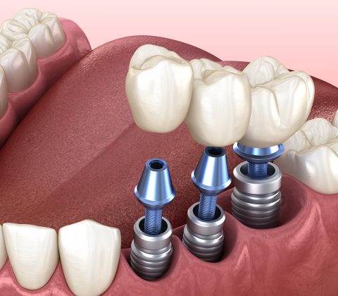 ایمپلنت دندانی، جراحی و گذاشتن فیکسچر های ایمپلنت و پروتزهای ایمپلنت