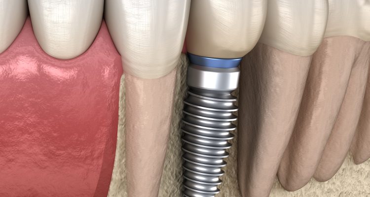 ایمپلنت دندان پرمولار، ماندگاری ایمپلنت دندانی