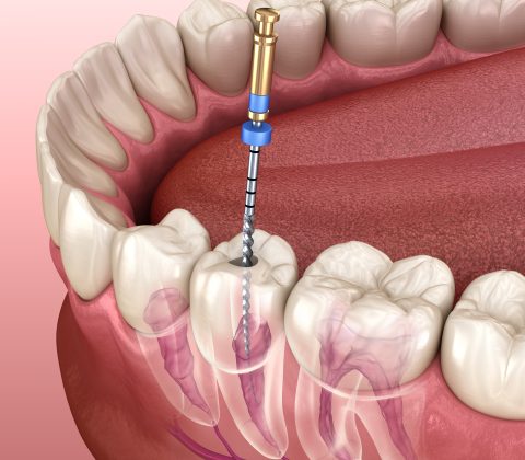 ابزار عصبکشی دندان فایل روتاری با دستگاه روتاری