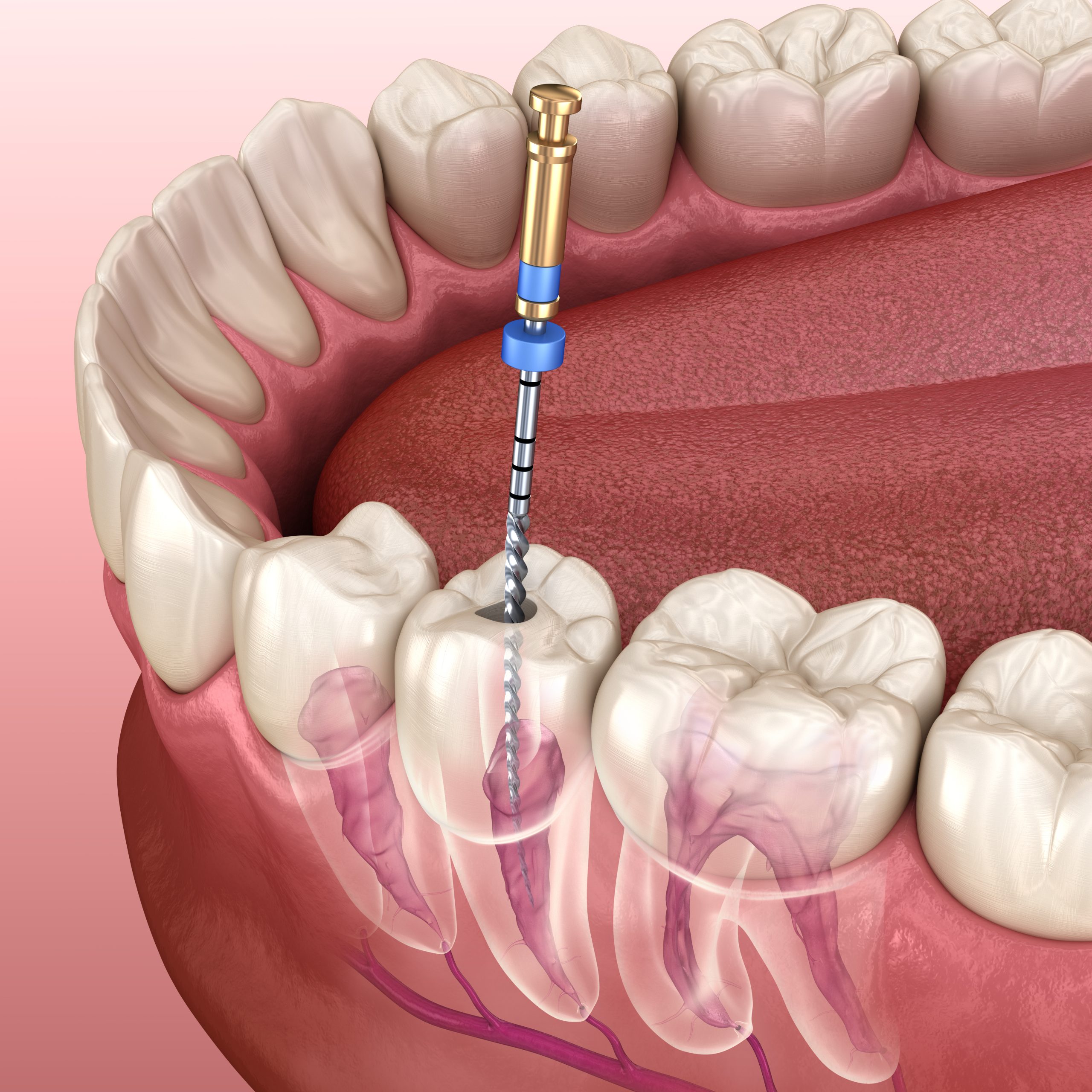 ابزار عصبکشی دندان فایل روتاری با دستگاه روتاری