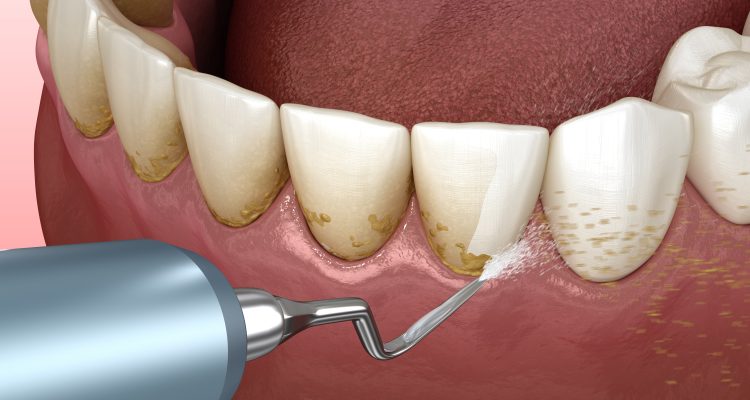 جرمگیری دندان و لثه و حذف پلاک های دندانی بین دندان و لثه