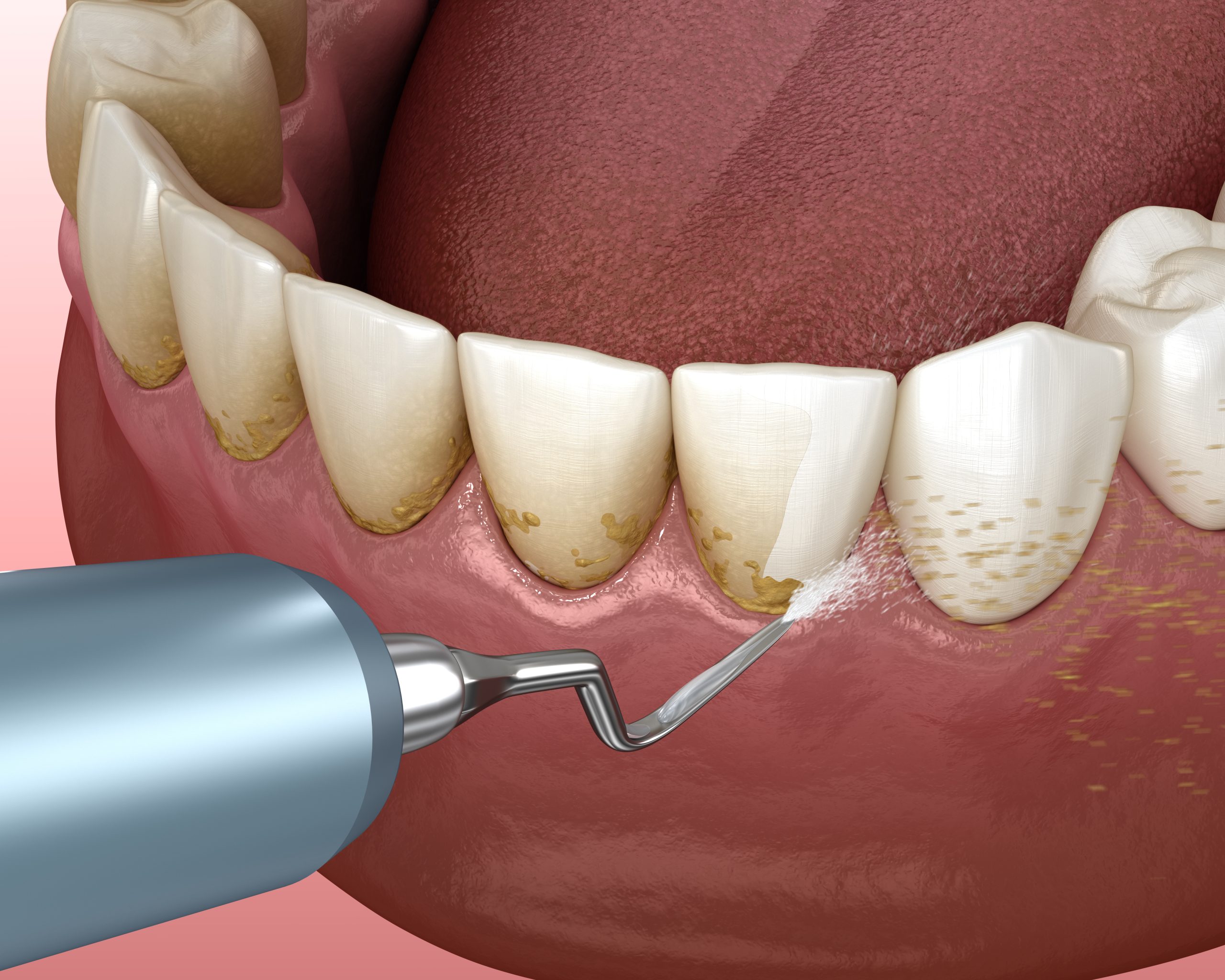جرمگیری دندان و لثه و حذف پلاک های دندانی بین دندان و لثه