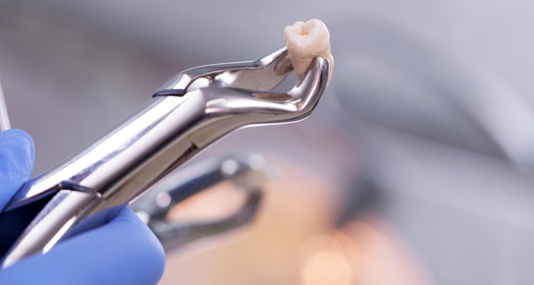 ابزار کشیدن و جراحی دندان عقل