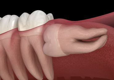 دندان عقل نهفته کج طوری که رشد آن از ناحیه تاج به سمت ریشه دندان 7 است