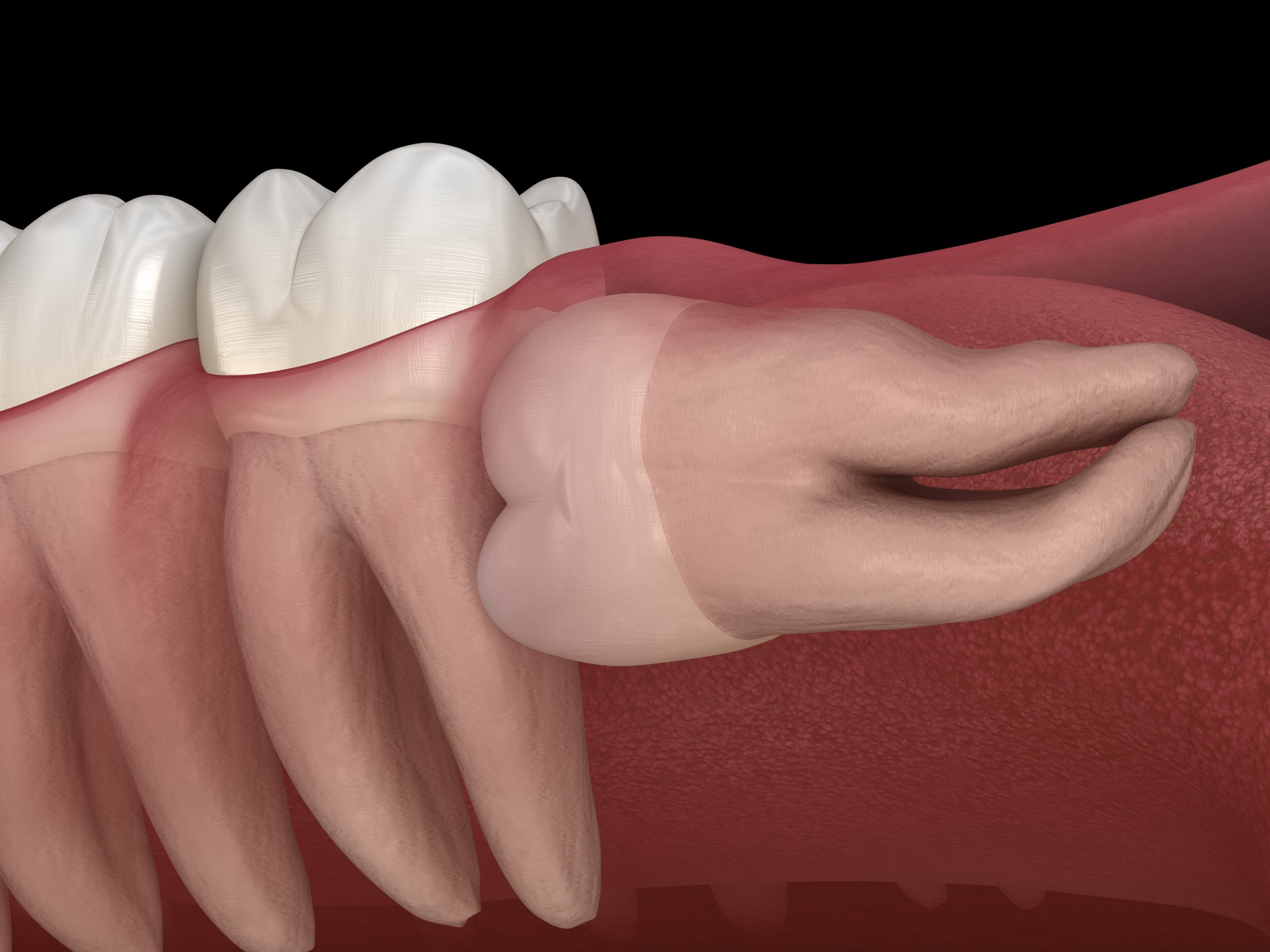 دندان عقل نهفته کج طوری که رشد آن از ناحیه تاج به سمت ریشه دندان 7 است