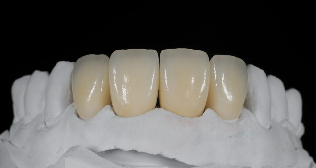 روکش های زیرکونیا ساخته شده در لابراتوار دندانپزشکی