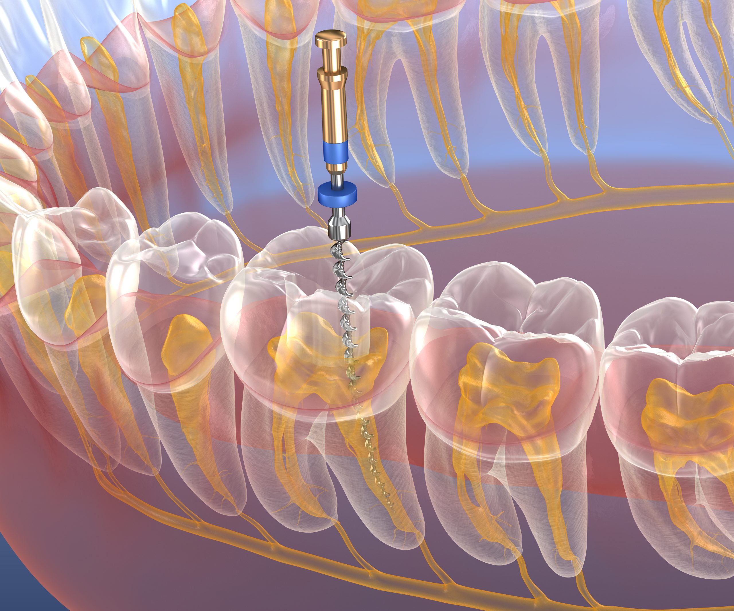 عصب کشی دندان 5 و بعد از آن روکش