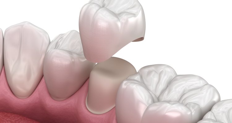 روکش دندانی بعد از عصب کشی
