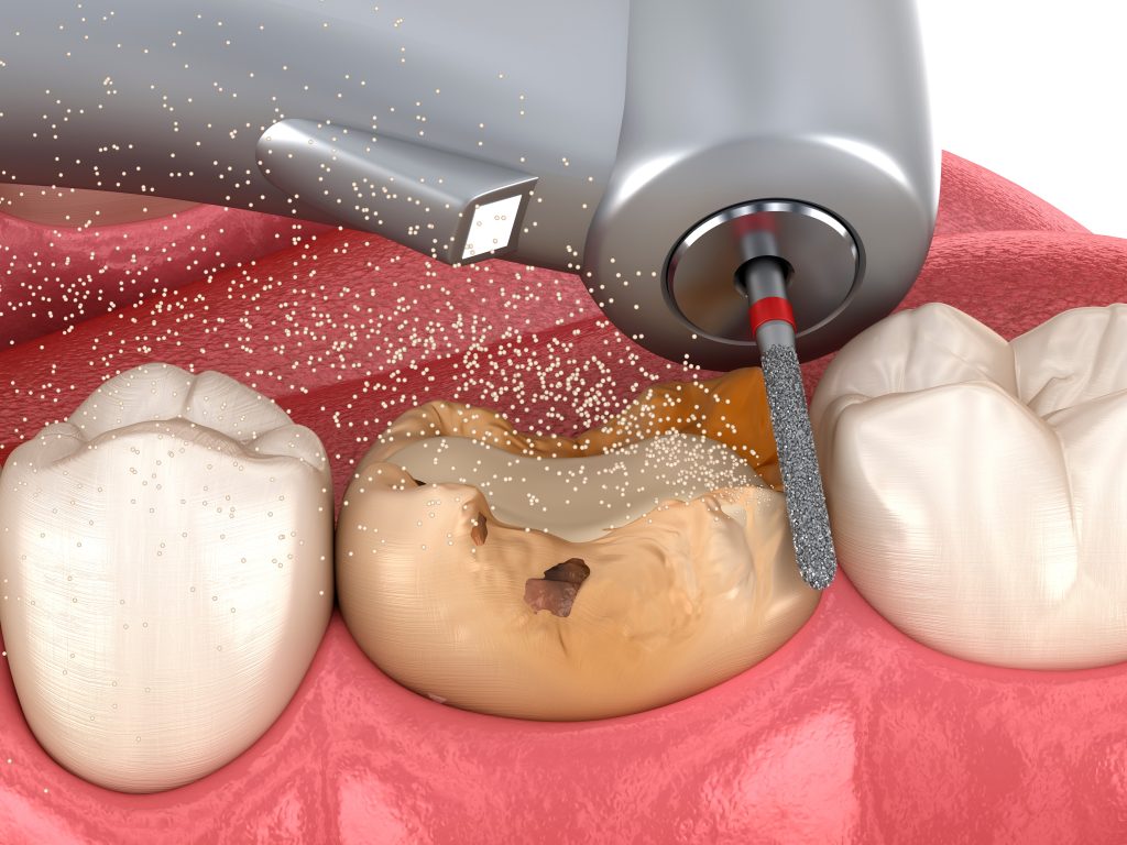 پاکسازی و تراشیدن اولیه پوسیدگی دندان با فرز دندانپزشکی اولین مرحله عصبکشی دندان
