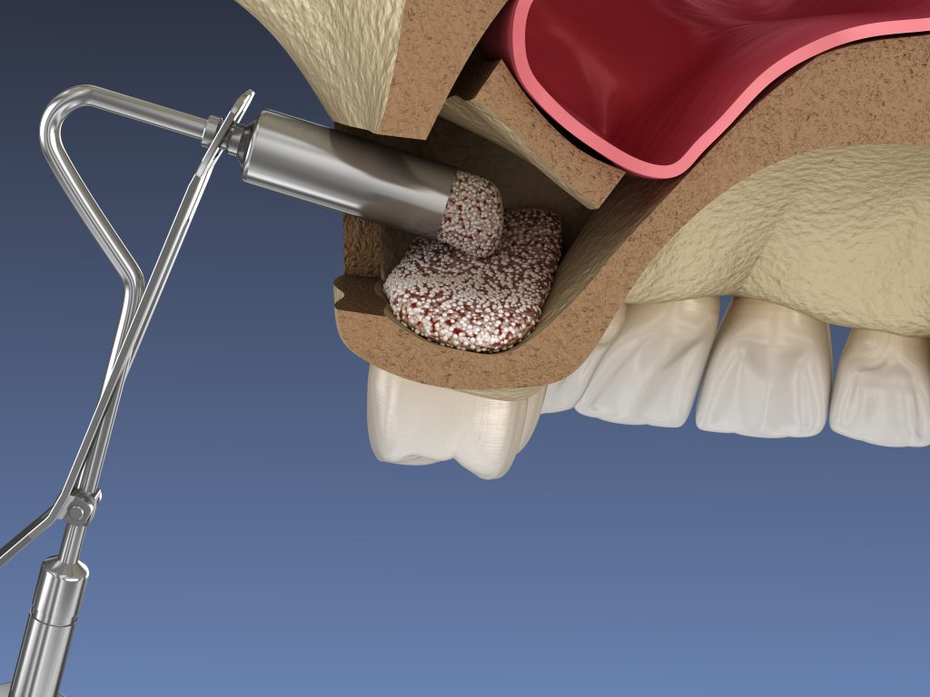 عمل جراحی سینوس لیفت - افزودن استخوان جدید یا پودر استخوان