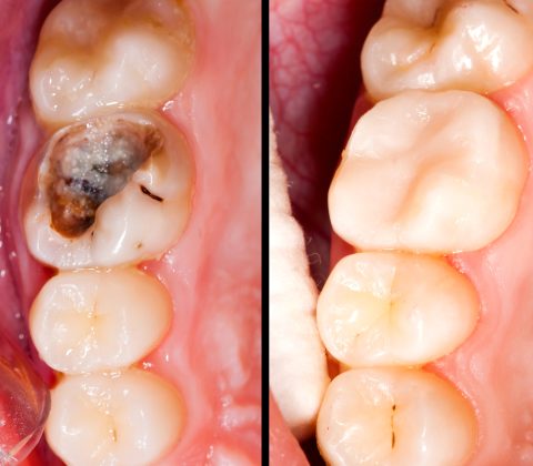 راهکارهای مراقبت از دندان و جلوگیری از پوسیدگی دندان