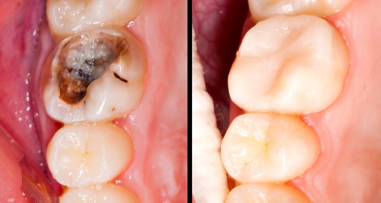 راهکارهای مراقبت از دندان و جلوگیری از پوسیدگی دندان