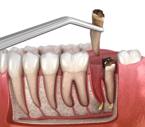 جراحی دندان در نسج سخت