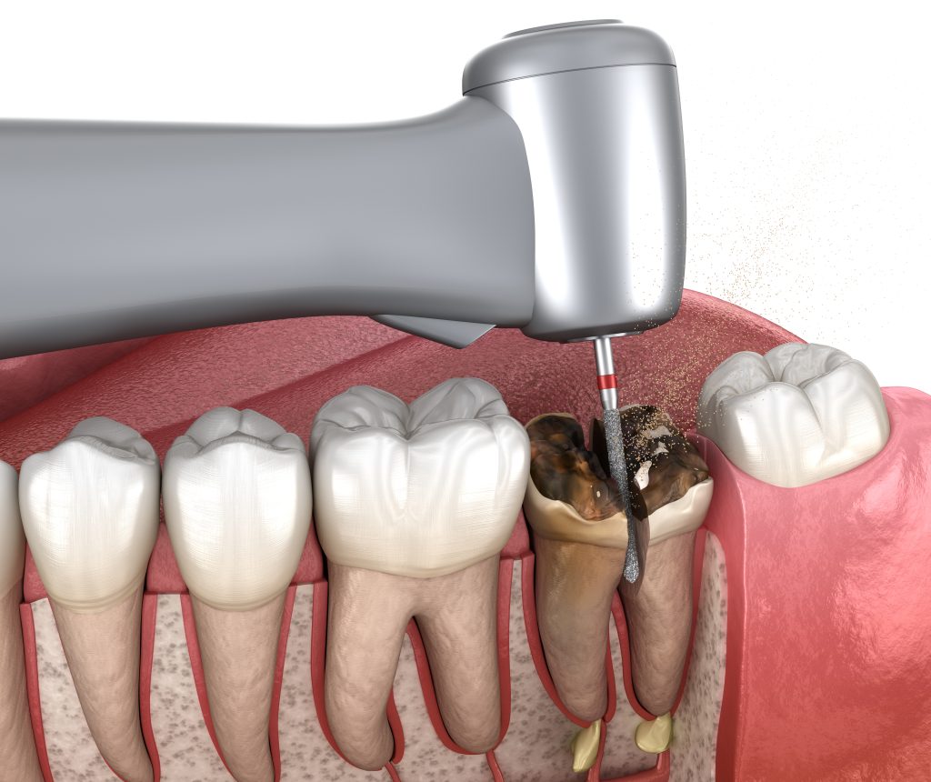 جراحی دندان در نسج سخت