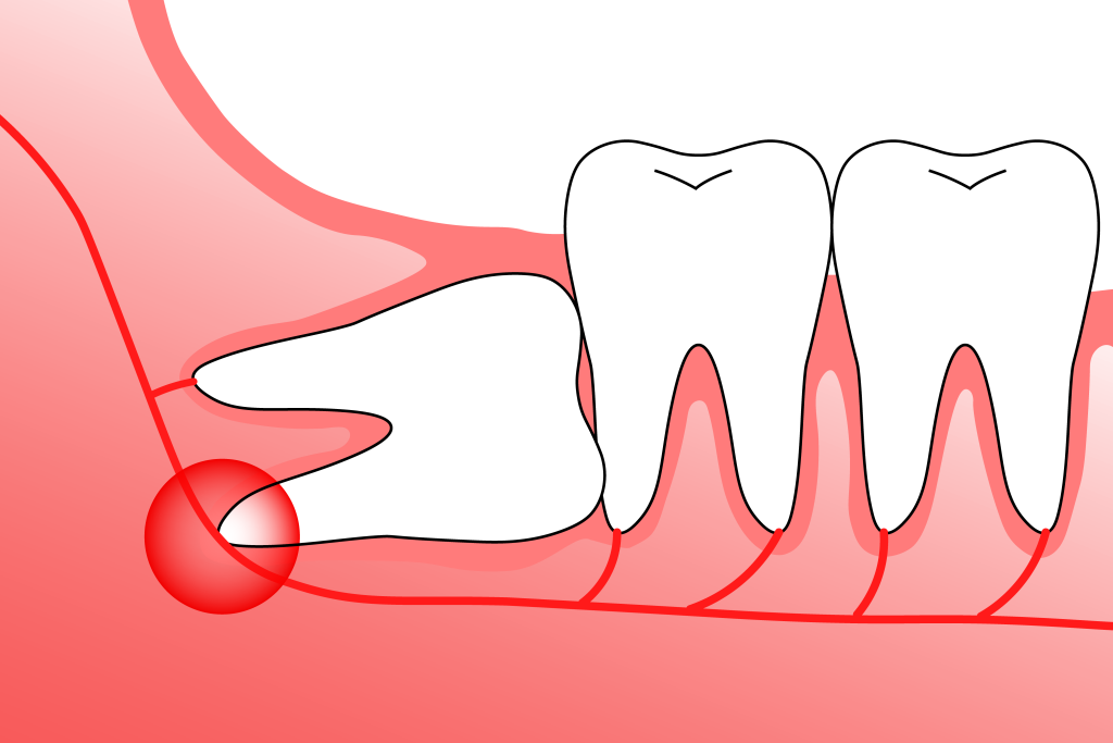 دندان عقل نهفته روی عصب اصلی فک