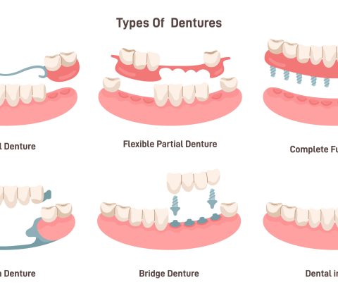 انواع دندان مصنوعی