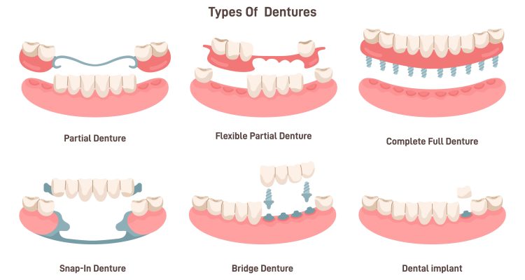 انواع دندان مصنوعی