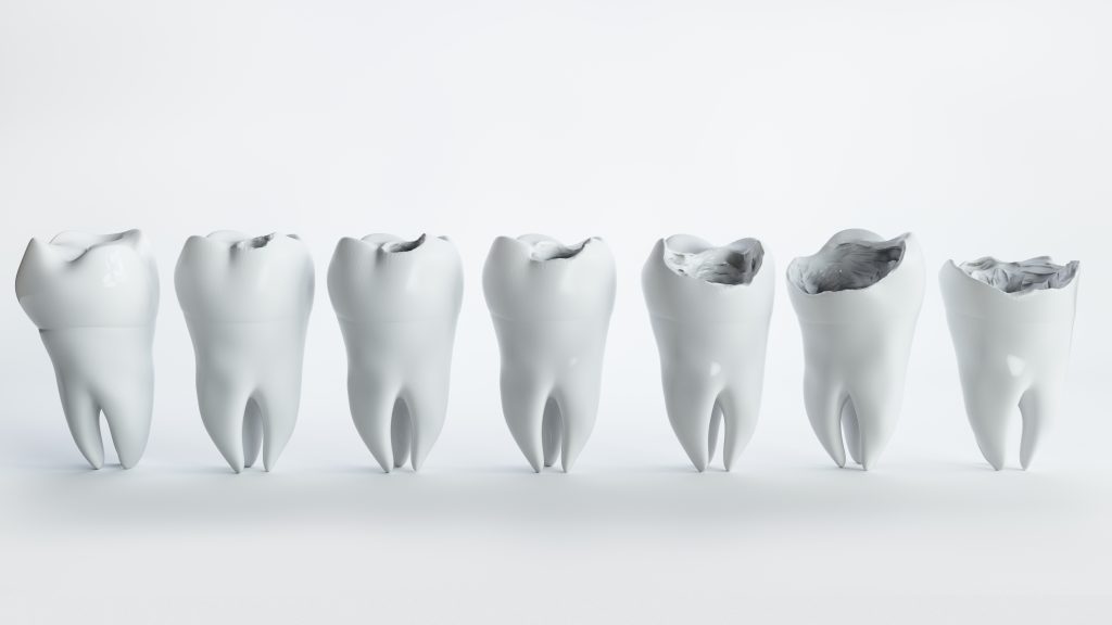 مراحل پوسیدگی دندان اگر پیشگیری نشود