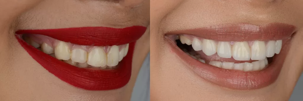 تصویر میزان تغییر سفیدی دندان با بلیچینگ 